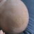 crosta lattea nei neonati